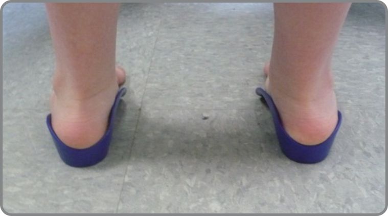 For Kids...Orthotics or Not? - Instructor Liesa M. Ritchie, PT, DPT, PCS, CKTP (FOR PRACTITIONERS)